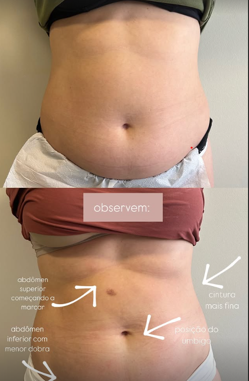 Resultado de tratamento estético 5